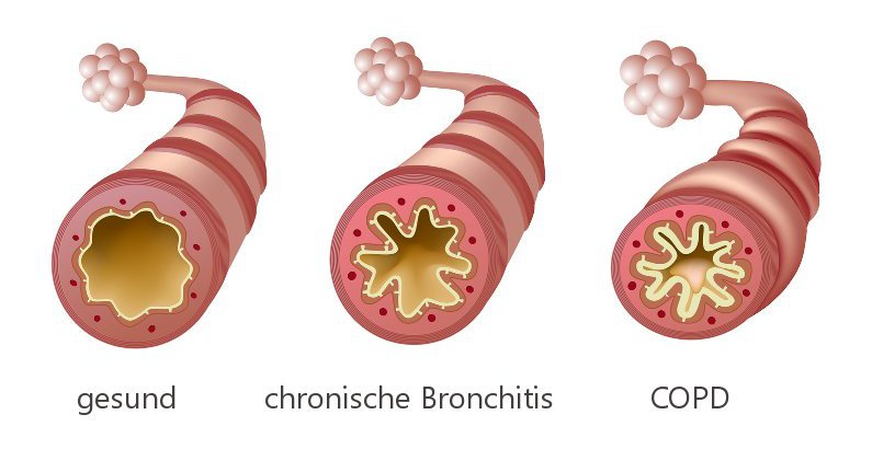 chronische bronchitis