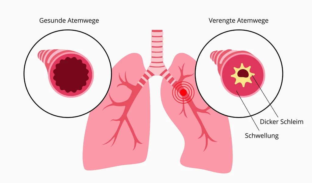 Schematische Illustration und Gegenüberstellung gesunder und verengter Atemwege