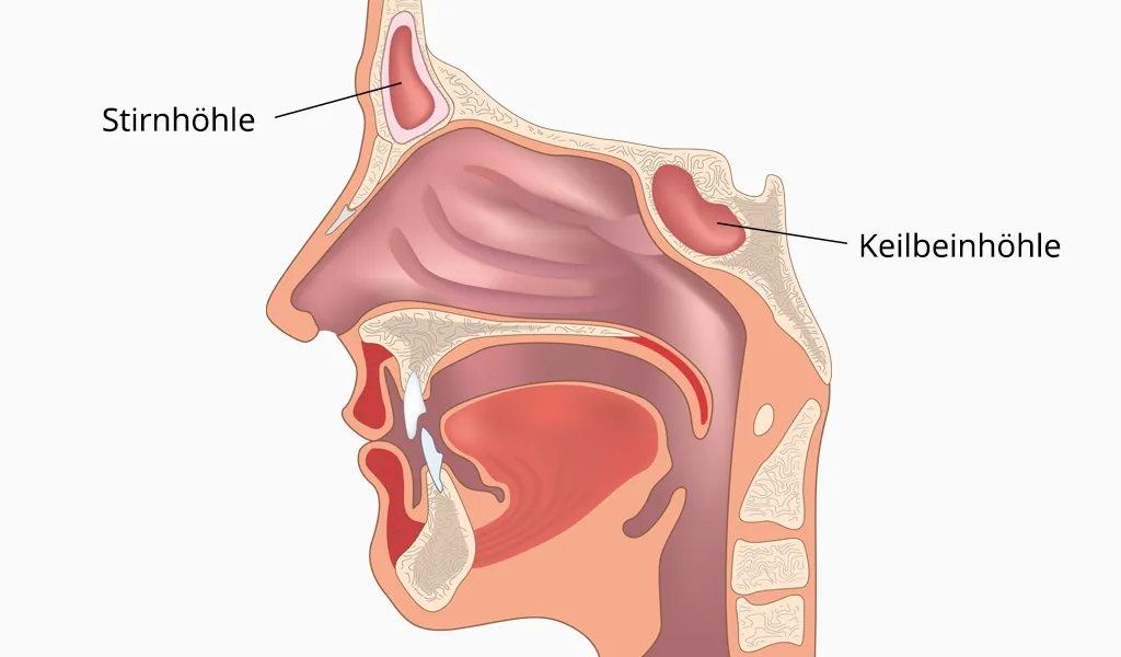 Chronische Sinusitis – Entzündung der Nasennebenhöhlen