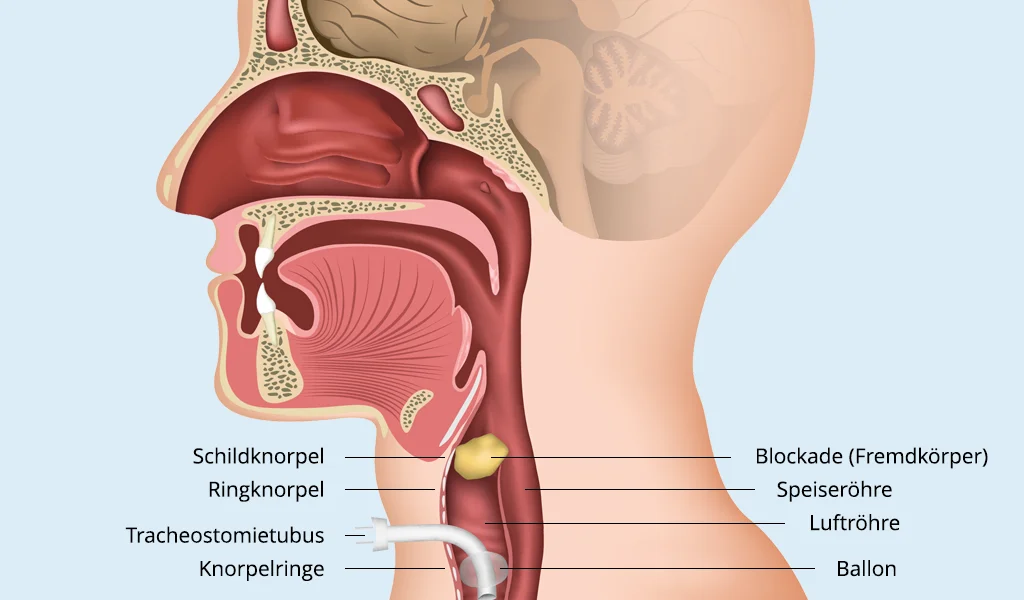 Schematische Darstellung eines Tracheostomas mit Tracheostomietubus und Ballon